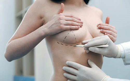 Cần tìm hiểu gì khi thay đổi kích thước ngực