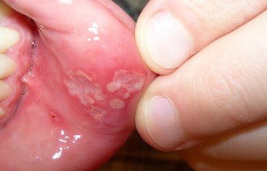 Triệu chứng viêm loét miệng do hoá trị phổ biến nhất Triệu chứng viêm loét miệng do hoá trị phổ biến nhất