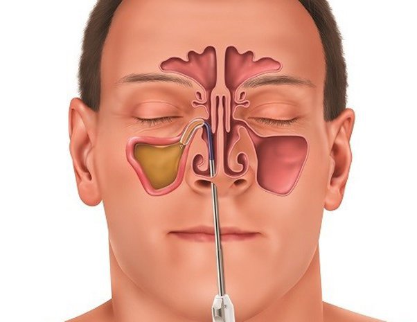 Nội soi hút dịch mũi xoang cho trẻ và các điều cha mẹ cần lưu ý