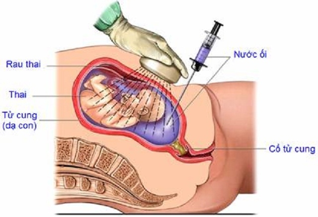 Sinh thiết nhau gai: Những điều cần biết Sinh thiết nhau gai: Những điều cần biết