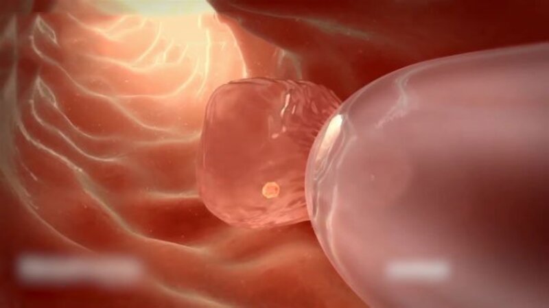 Quá trình chuyển phôi là gì? Những lưu ý trước khi thực hiện chuyển phôi