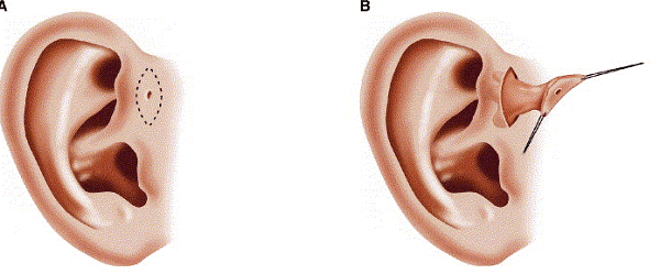 Triệu chứng và cách chữa bệnh rò luân nhĩ Triệu chứng và cách chữa bệnh rò luân nhĩ