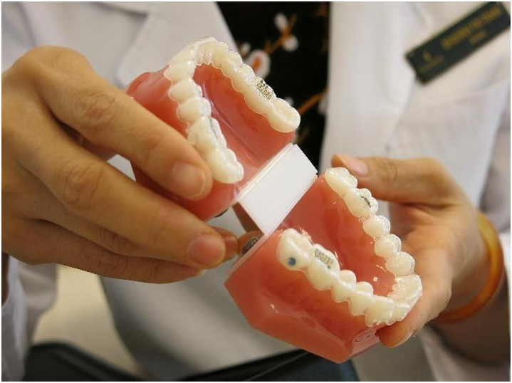 Niềng răng giá rẻ - Nguy cơ tiềm ẩn Niềng răng