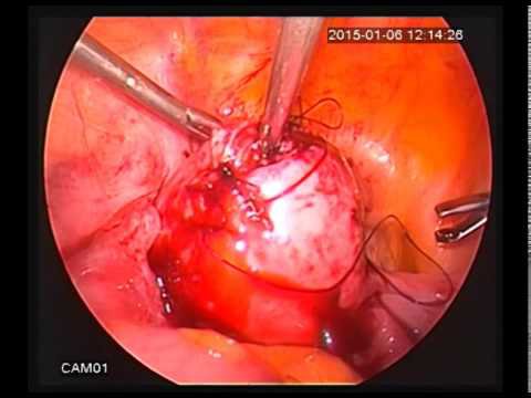 Bóc nhân xơ tử cung là gì? Ưu điểm của nội soi bóc nhân xơ tử cung