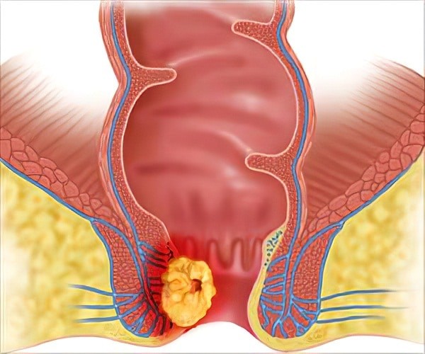 Phân biệt ung thư hậu môn và bệnh trĩ Phân biệt ung thư hậu môn và bệnh trĩ