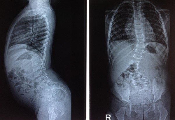 Phẫu thuật chỉnh vẹo cột sống cho trẻ và những điều cần biết Phẫu thuật chỉnh vẹo cột sống cho trẻ và những điều cần biết