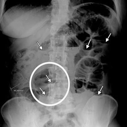 Khám phá về phẩu thuật tắc ruột phân su Khám phá về phẩu thuật tắc ruột phân su