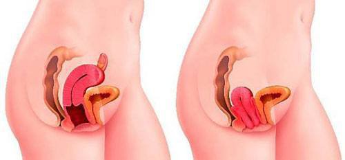 Phẫu thuật treo tử cung- bàng quang vào mỏm nhô Phẫu thuật treo tử cung- bàng quang vào mỏm nhô