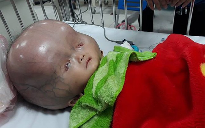 Phương pháp thực hiện chẩn đoán bằng siêu âm qua thóp