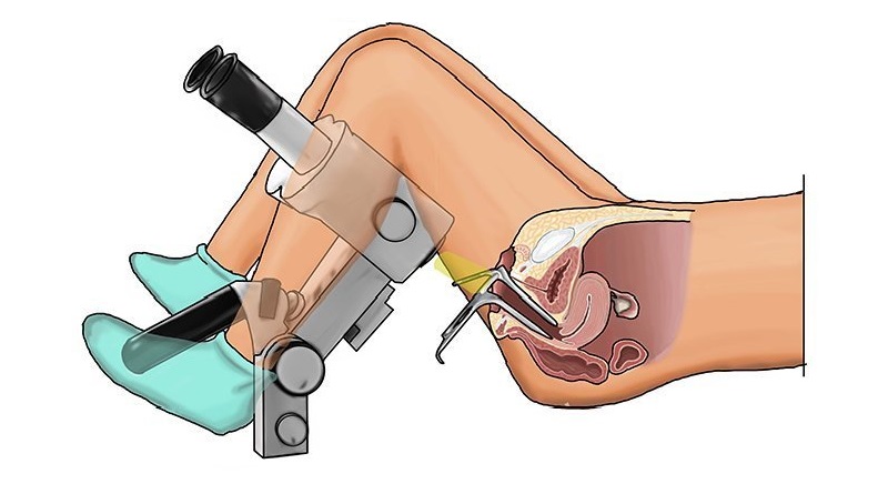 Soi cổ tử cung - biện pháp giúp phát hiện sớm ung thư cổ tử cung Soi cổ tử cung - biện pháp giúp phát hiện sớm ung thư cổ tử cung