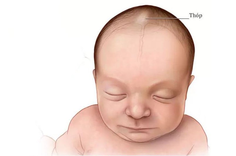 Nhận biết khi thóp trẻ phập phồng bất thường và cách chăm sóc