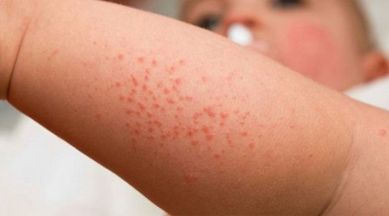 Tìm hiểu về rối loạn giảm tiểu cầu ở trẻ em