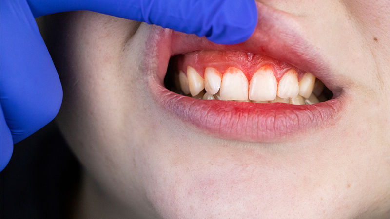 Tìm hiểu về rối loạn giảm tiểu cầu ở trẻ em