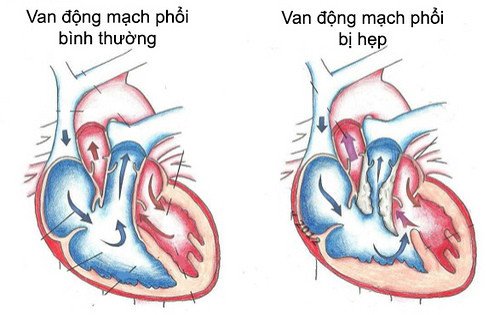 Triệu chứng và cách chữa bệnh hẹp van động mạch phổi ở trẻ em Triệu chứng và cách chữa bệnh hẹp van động mạch phổi ở trẻ em