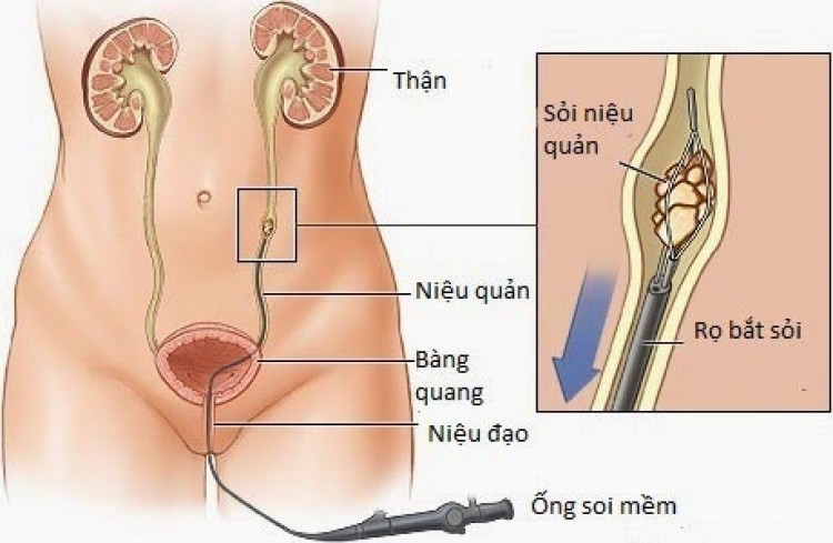 Tìm hiểu về bệnh nang niệu quản (túi sa niệu quản) bẩm sinh Tìm hiểu về bệnh nang niệu quản (túi sa niệu quản) bẩm sinh