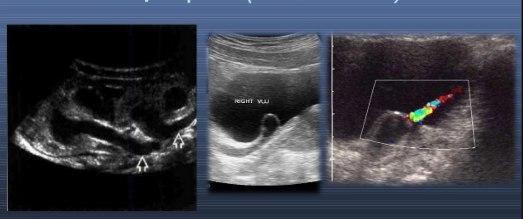 Tìm hiểu về bệnh nang niệu quản (túi sa niệu quản) bẩm sinh Tìm hiểu về bệnh nang niệu quản (túi sa niệu quản) bẩm sinh