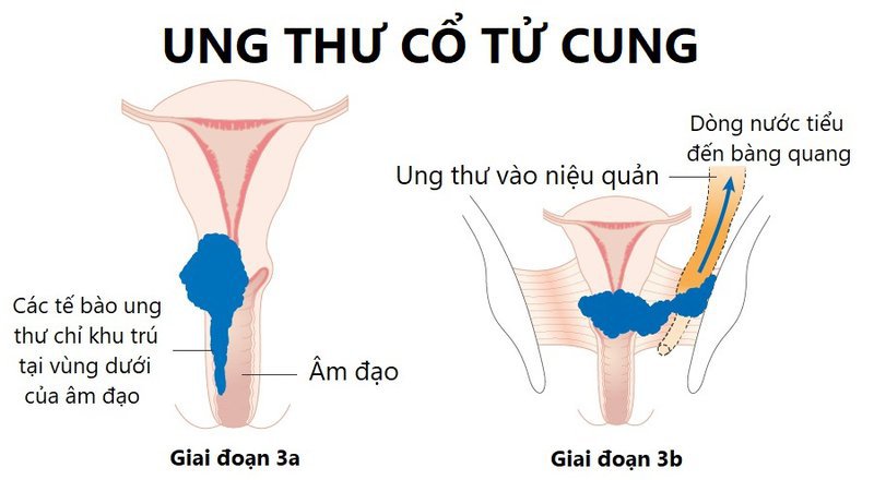 Triệu chứng ung thư cổ tử cung giai đoạn 3 Triệu chứng ung thư cổ tử cung giai đoạn 3 và cách điều trị hiện nay