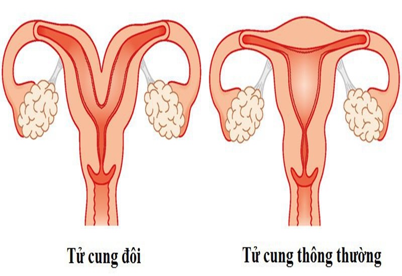 Tử cung đôi là gì? Ảnh hưởng của tử cung đôi và nguy cơ sảy thai