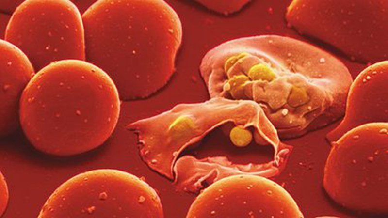 Tầm quan trọng của sức bền hồng cầu trong bệnh lý huyết sắc tố và thiếu máu tan máu Tầm quan trọng của sức bền hồng cầu trong bệnh lý huyết sắc tố và thiếu máu tan máu
