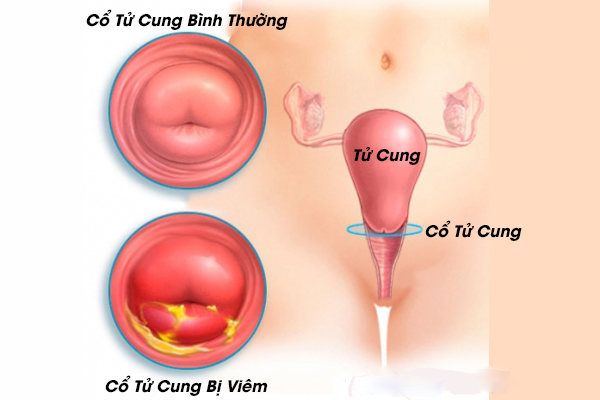 Viêm cổ tử cung là gì? Cảnh báo về viêm cổ tử cung