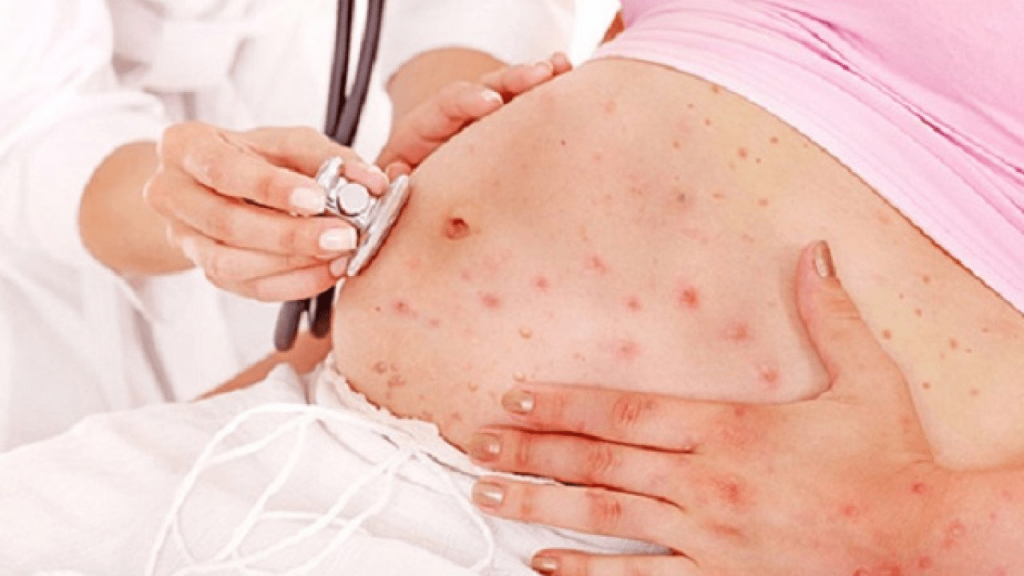 Mọc mụn ở bà bầu - Cách chăm sóc 5 cách trị mụn cho bà bầu an toàn cho cả mẹ và con