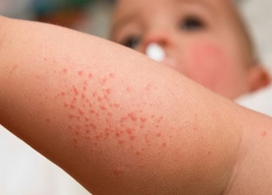 Ngừa bệnh ngoài da cho bé khi trời nóng