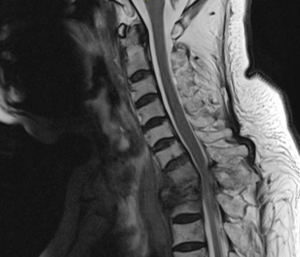 Triệu chứng và cách phòng tránh bệnh đa u tủy