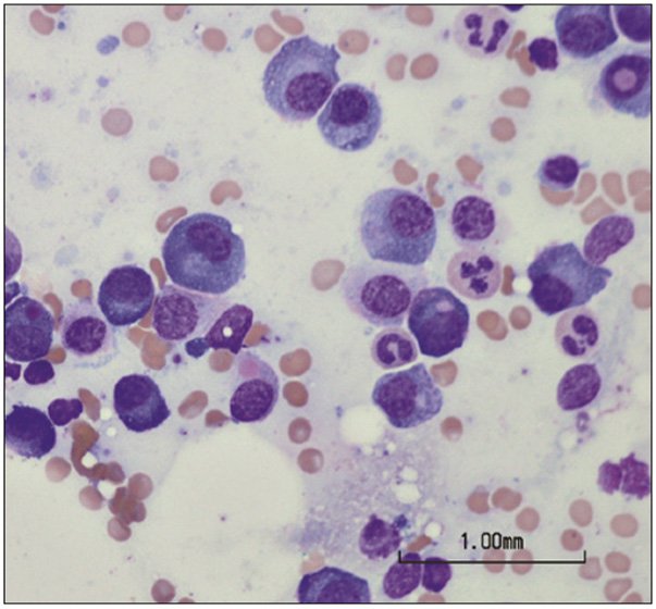 Triệu chứng và cách phòng tránh bệnh đa u tủy