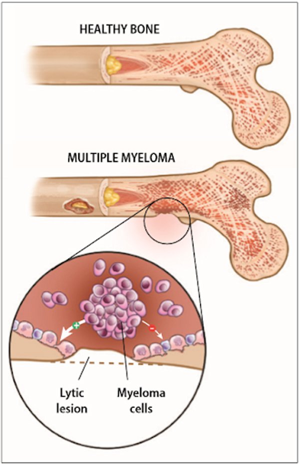 Triệu chứng và cách phòng tránh bệnh đa u tủy