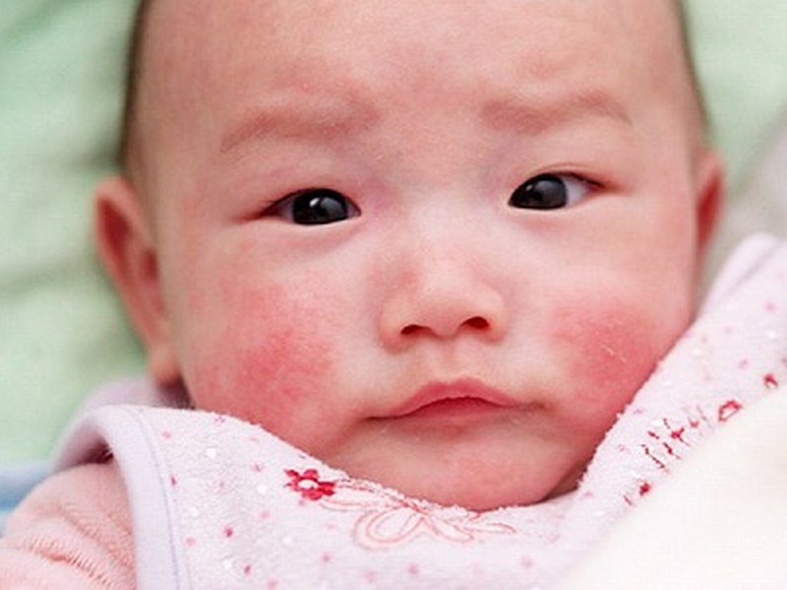 Dấu hiệu và cách phòng tránh bênh lupus ban đỏ ở trẻ sơ sinh