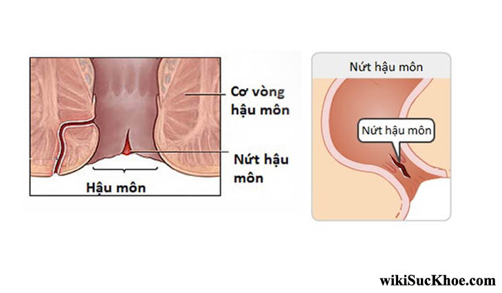 Bệnh nứt hậu môn: Khái niệm, nguyên nhân, triệu chứng và phòng ngừa -  wikiSucKhoe