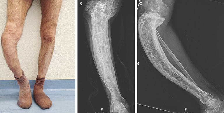 Bệnh paget xương là gì? Điều trị bệnh paget xương? Bệnh paget xương là gì? Điều trị bệnh paget xương?