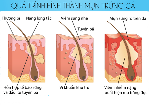 Phương pháp trị mụn trứng cá hiệu quả nhất