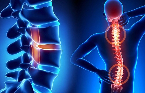 Bệnh xương khớp - Bệnh nhiều người mắc phải nhất trên thế giới Lao các khớp khác: một trong những thể bệnh hay gặp của lao xương khớp