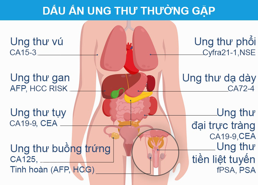 Tổng quan về các chỉ dấu ung thư quan trọng thường được sử dụng hiện nay Tổng quan về các chỉ dấu ung thư quan trọng thường được sử dụng hiện nay