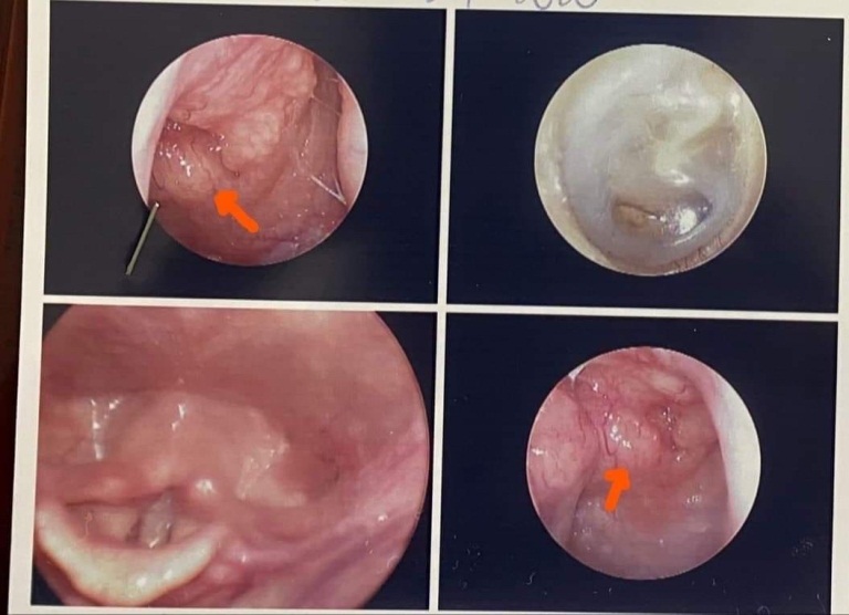 Biểu hiện cảnh báo có nguy cơ bị ung thư vòm họng Biểu hiện cảnh báo có nguy cơ bị ung thư vòm họng