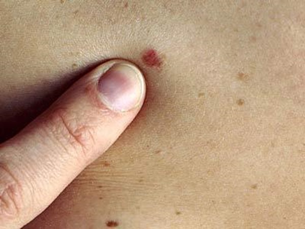 Phân biệt giai đoạn khác nhau của ung thư máu Phân biệt giai đoạn khác nhau của ung thư máu