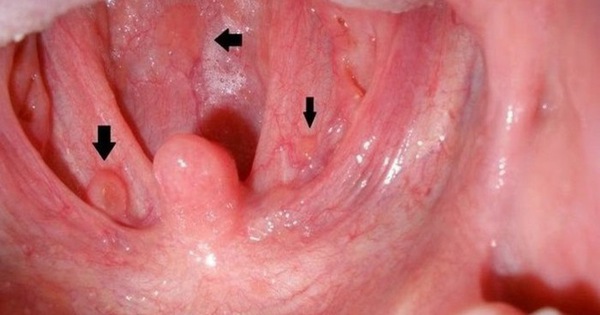 Các giai đoạn phát triển và diễn biến của ung thư vòm họng