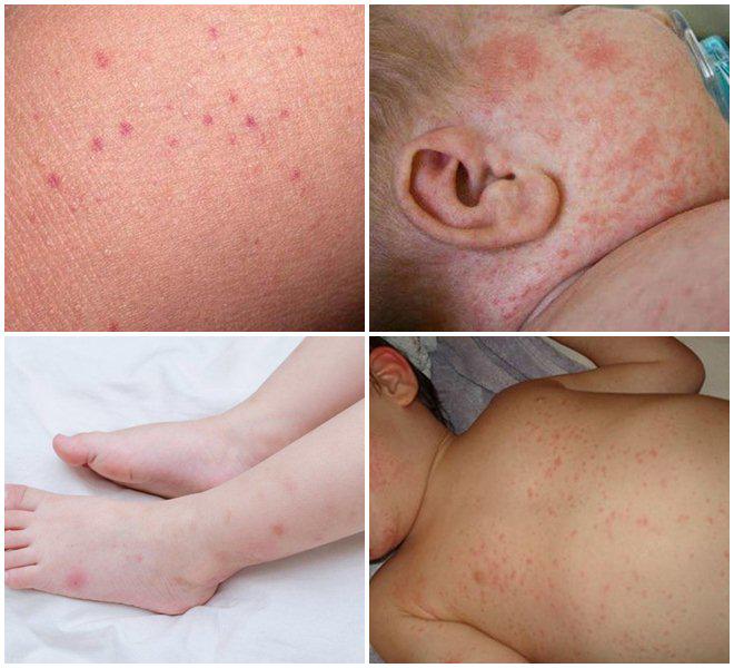 Phương pháp điều trị sốt xuất huyết ở trẻ em