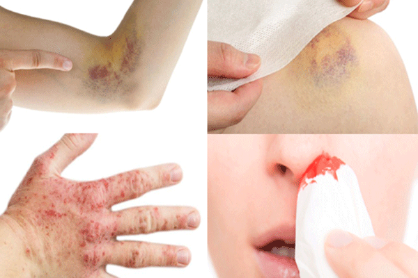 Lý do thường gặp gây ung thư máu bạn nên biết Lý do thường gặp gây ung thư máu bạn nên biết