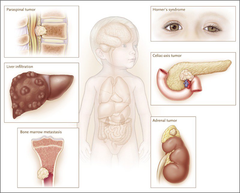 Triệu chứng và cách chữa trị u nguyên bào thần kinh Triệu chứng và cách chữa trị u nguyên bào thần kinh