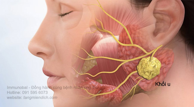 Dấu hiệu cảnh báo sớm bệnh ung thư vòm họng