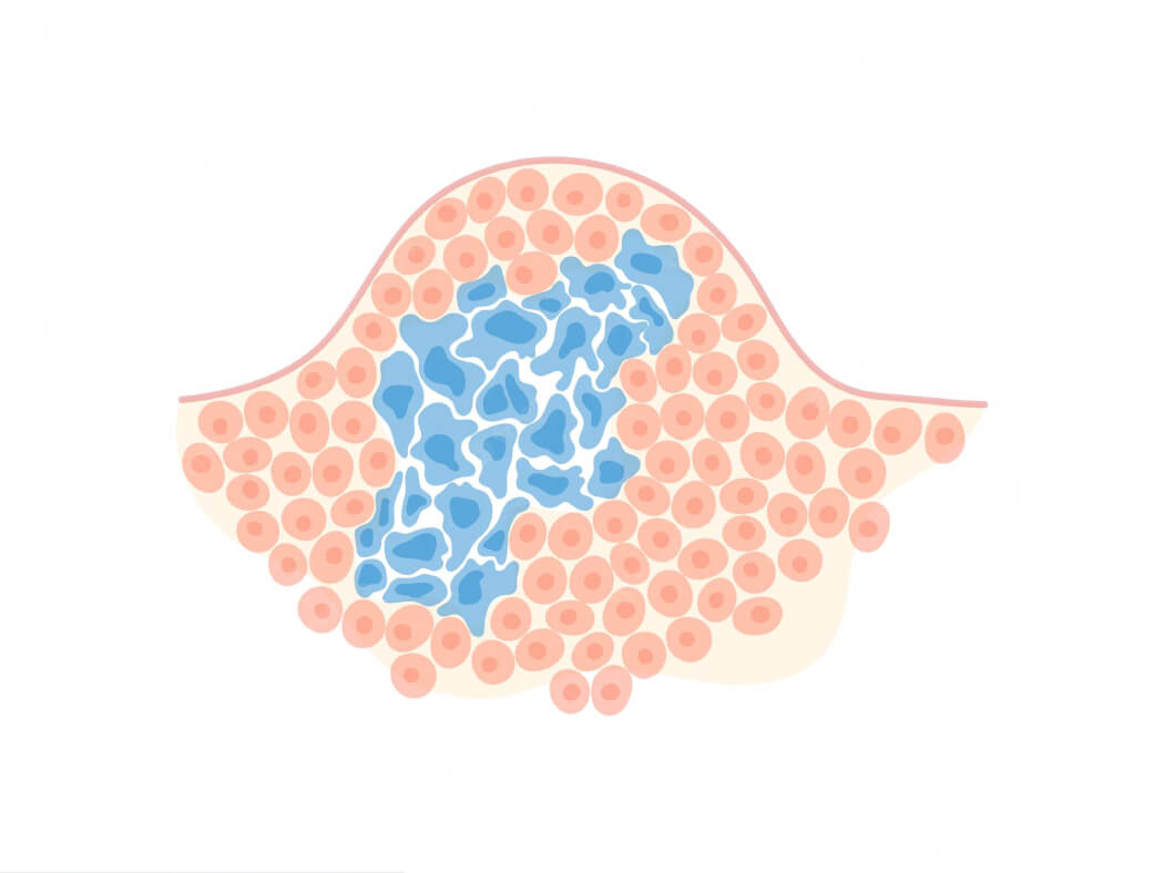 Phương pháp chẩn đoán phân biệt u ác - u lành nhờ hóa mô miễn dịch
