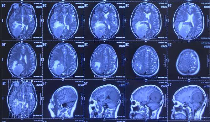 Phương pháp chẩn đoán u màng não bằng cộng hưởng từ MRI Phương pháp chẩn đoán u màng não bằng cộng hưởng từ MRI