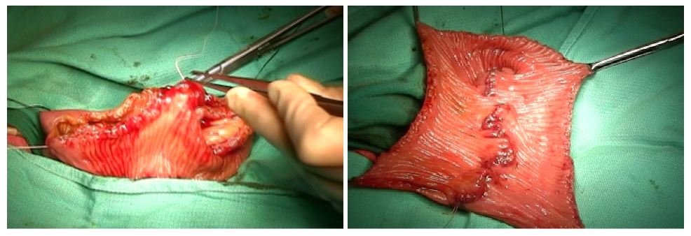 Triệu chứng và cách phòng tránh bệnh u bàng quang hiệu quả