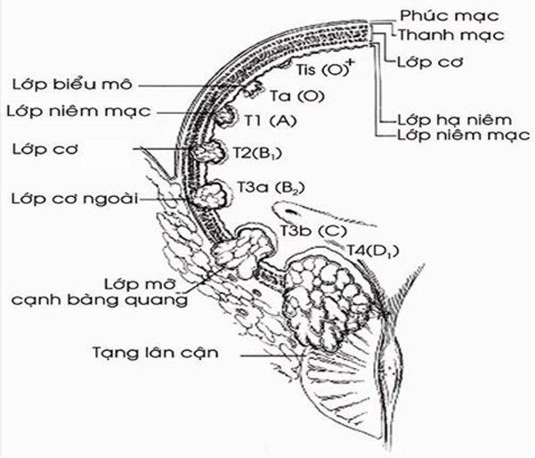Triệu chứng và cách phòng tránh bệnh u bàng quang hiệu quả