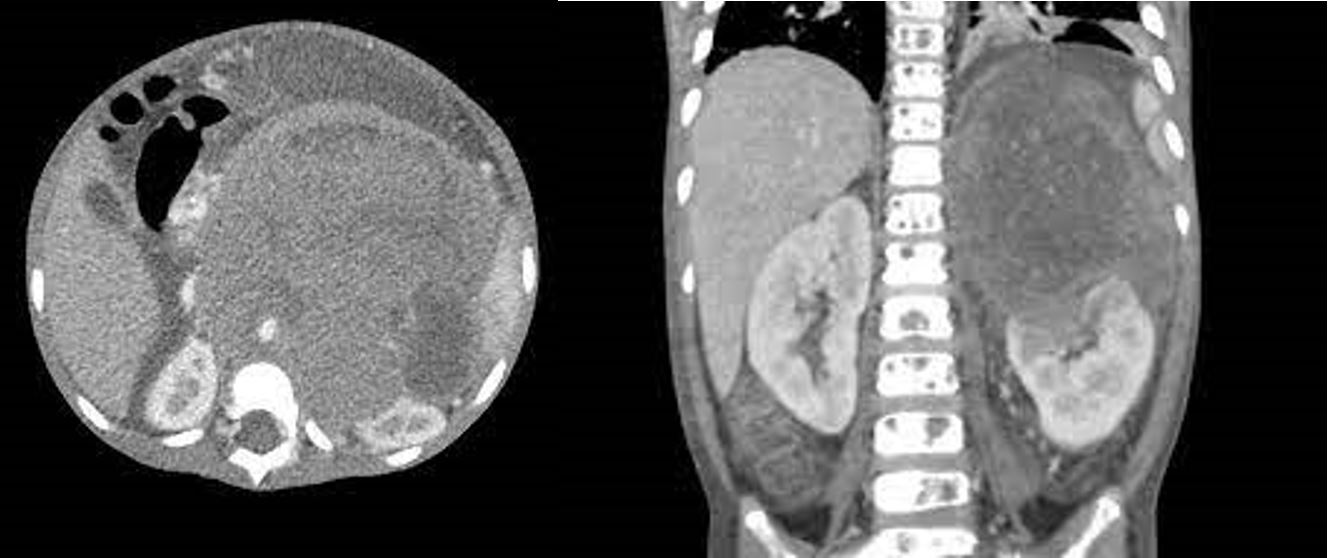 Dấu hiệu nhận biết và cách chữa trị u nguyên bào thần kinh đệm Dấu hiệu nhận biết và cách chữa trị u nguyên bào thần kinh đệm