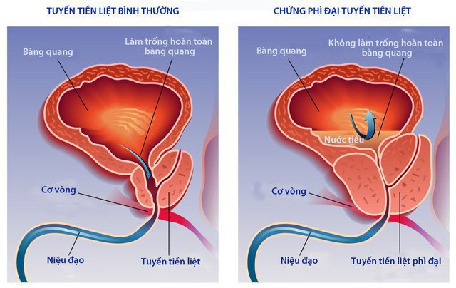 Chỉ số PSA và fPSA trong chẩn đoán ung thư tiền liệt tuyến Chỉ số PSA và fPSA trong chẩn đoán ung thư tiền liệt tuyến