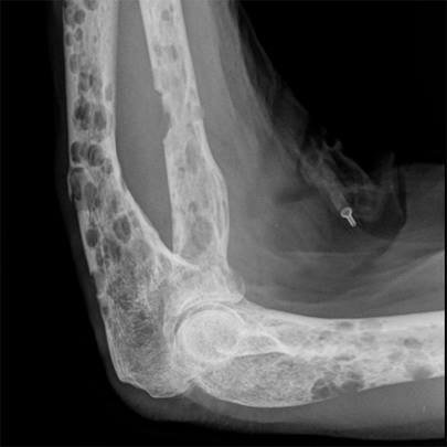 Đa u tủy: Nguyên nhân, biểu hiện