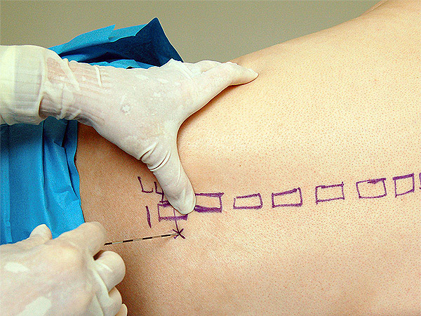 Gây tê màng cứng là gì? Có nên gây tê màng kính khi sinh? Các mẹ cần biết: Phân biệt gây tê tủy sống và gây tê ngoài màng cứng